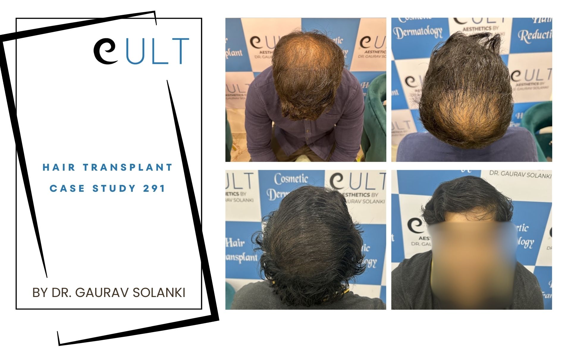 Hair Transplant case 291