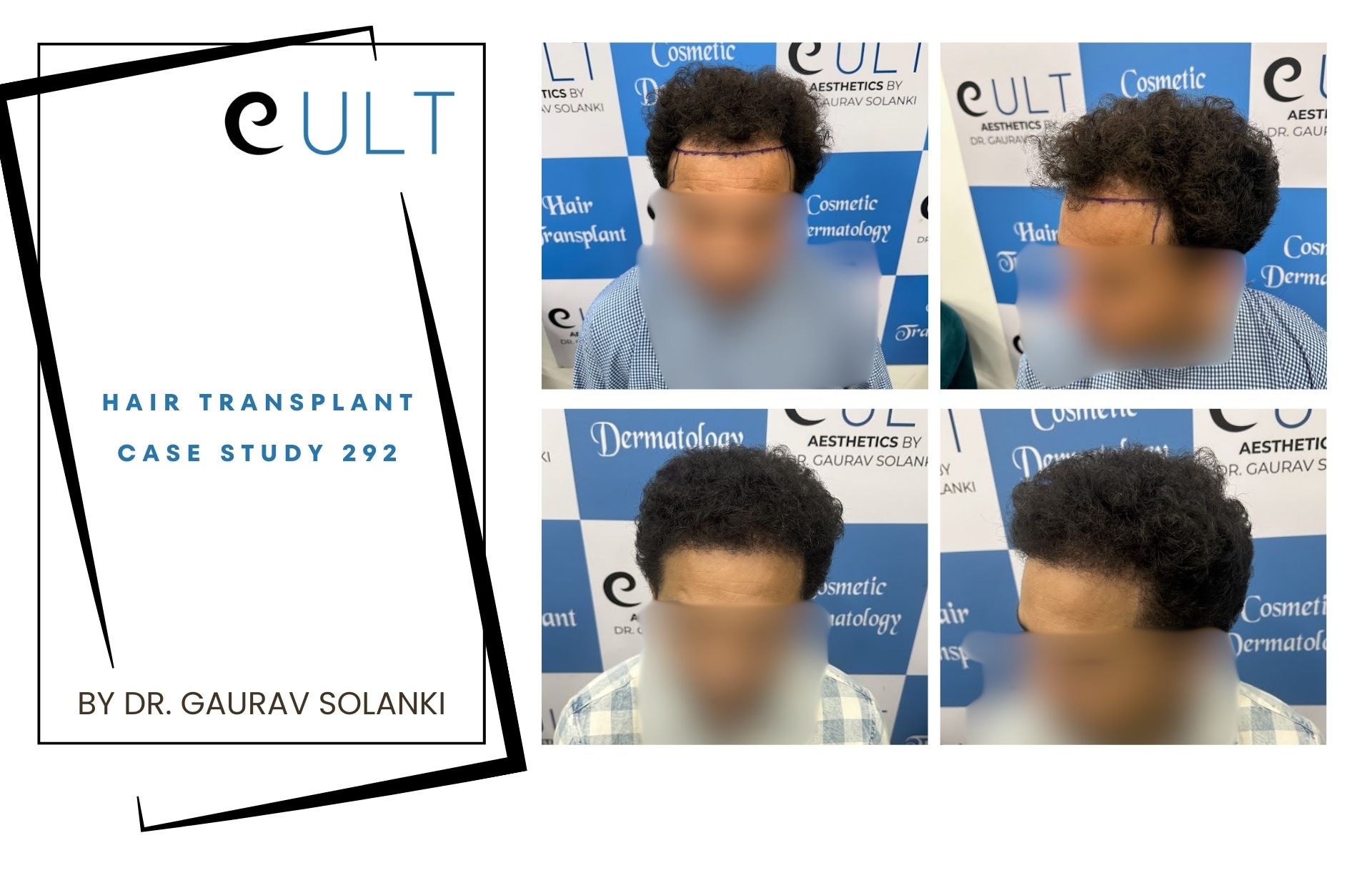 Hair Transplant case 292