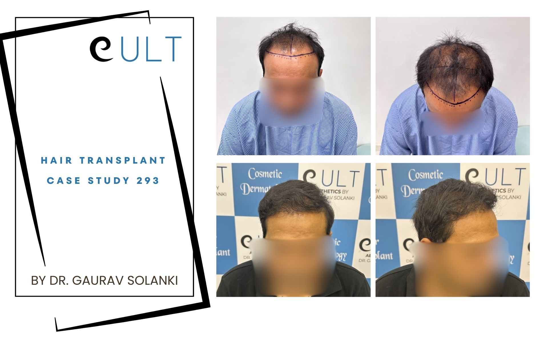 Hair Transplant case 293