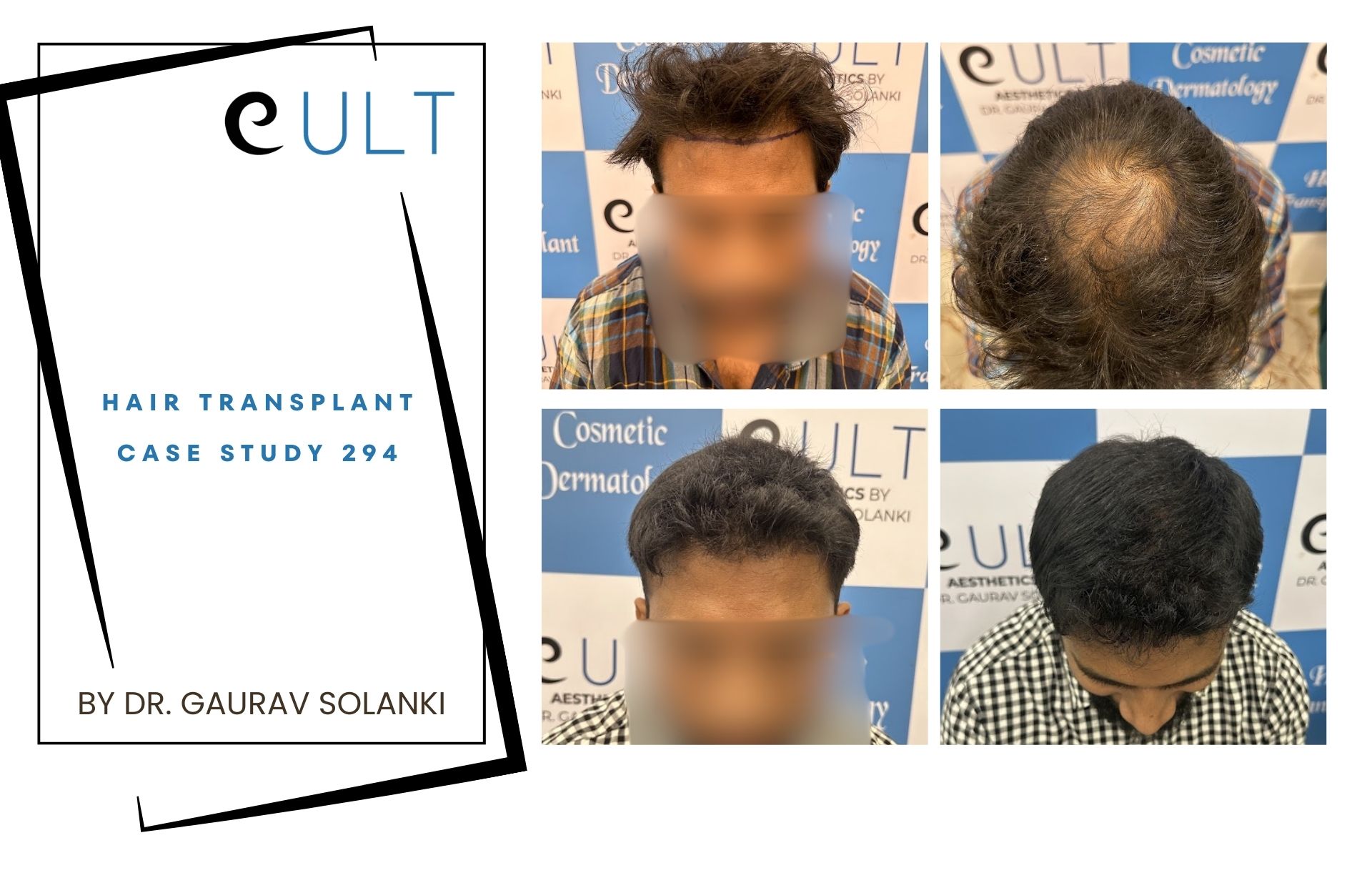 Hair Transplant case 294