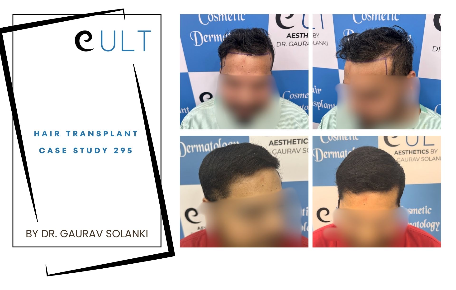 Hair Transplant case 295