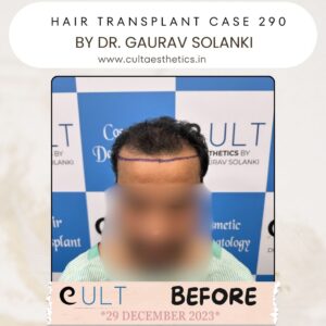 Hair Transplant Case 290 - Before Treatment at Cult Aesthetics Gurgaon