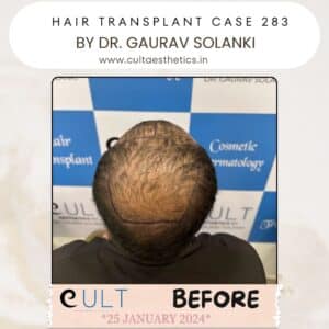 Hair Transplant Case 283 - Before Treatment at Cult Aesthetics Gurgaon