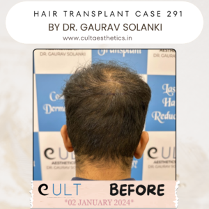 Hair Transplant Case 291 - Before Treatment at Cult Aesthetics Gurgaon