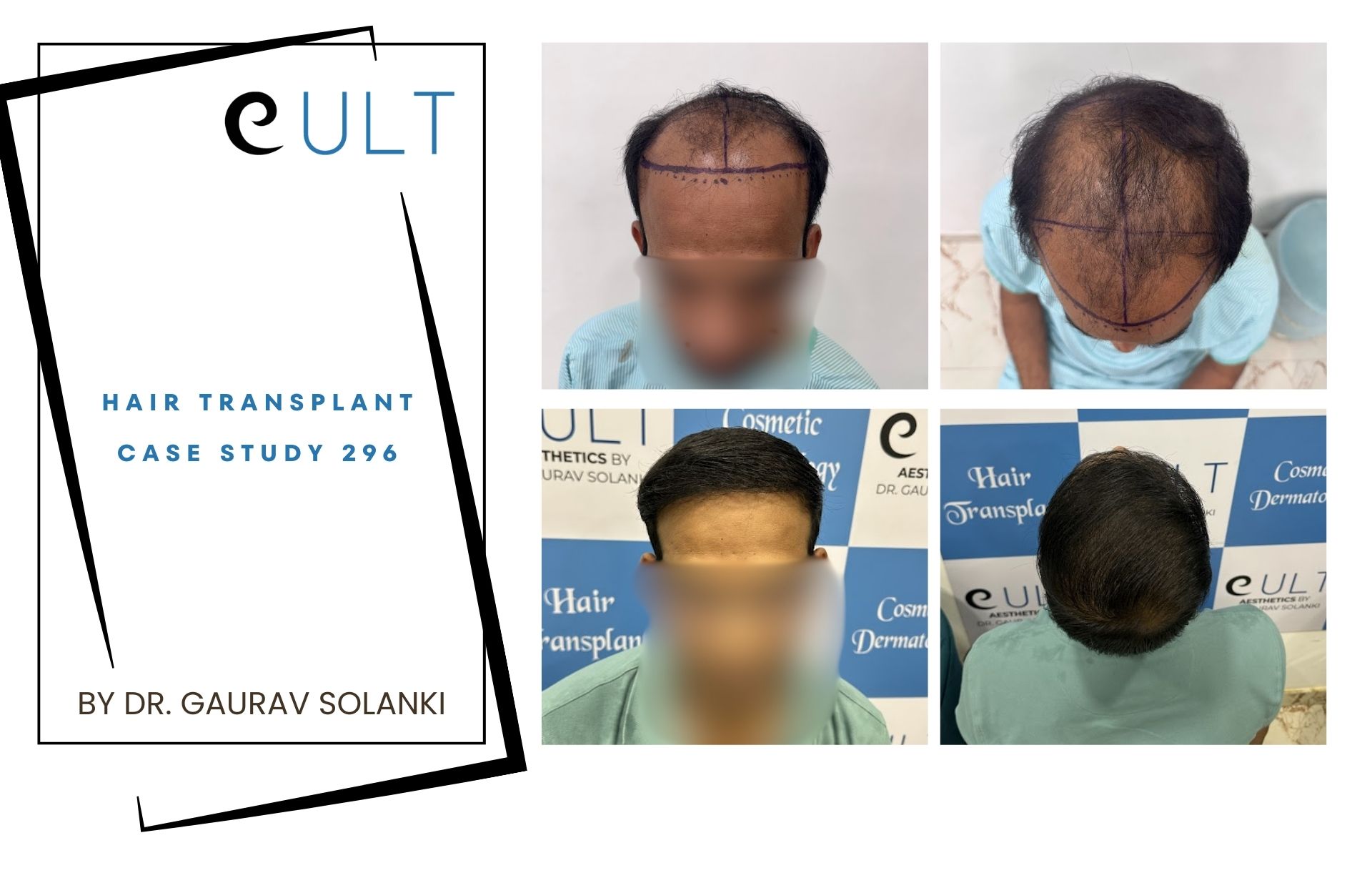 Hair Transplant case 296