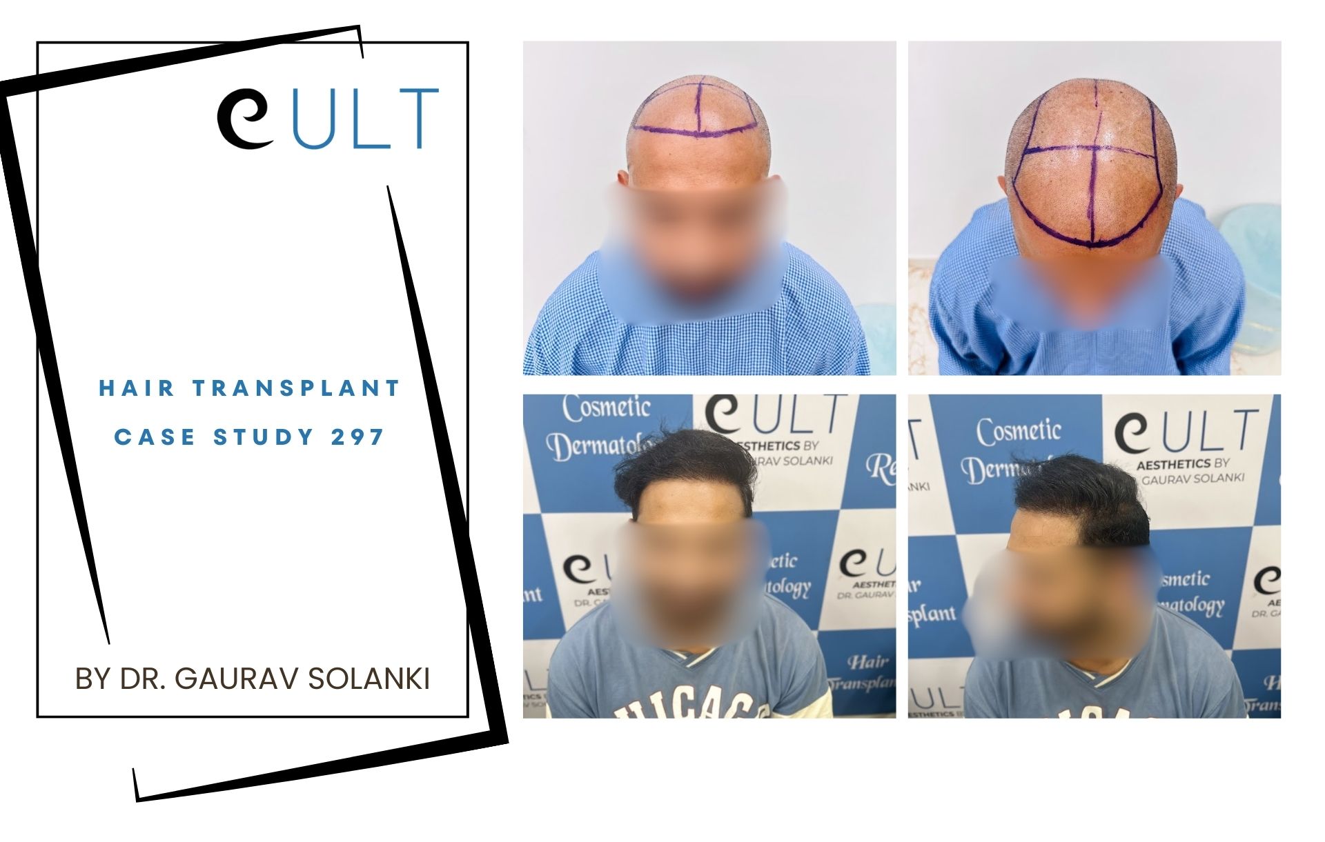 Hair Transplant case 297