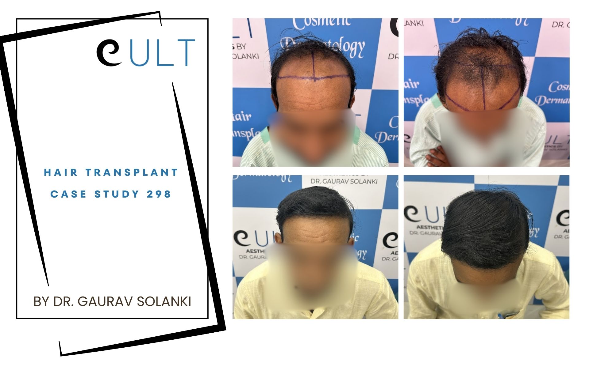 Hair Transplant case 298