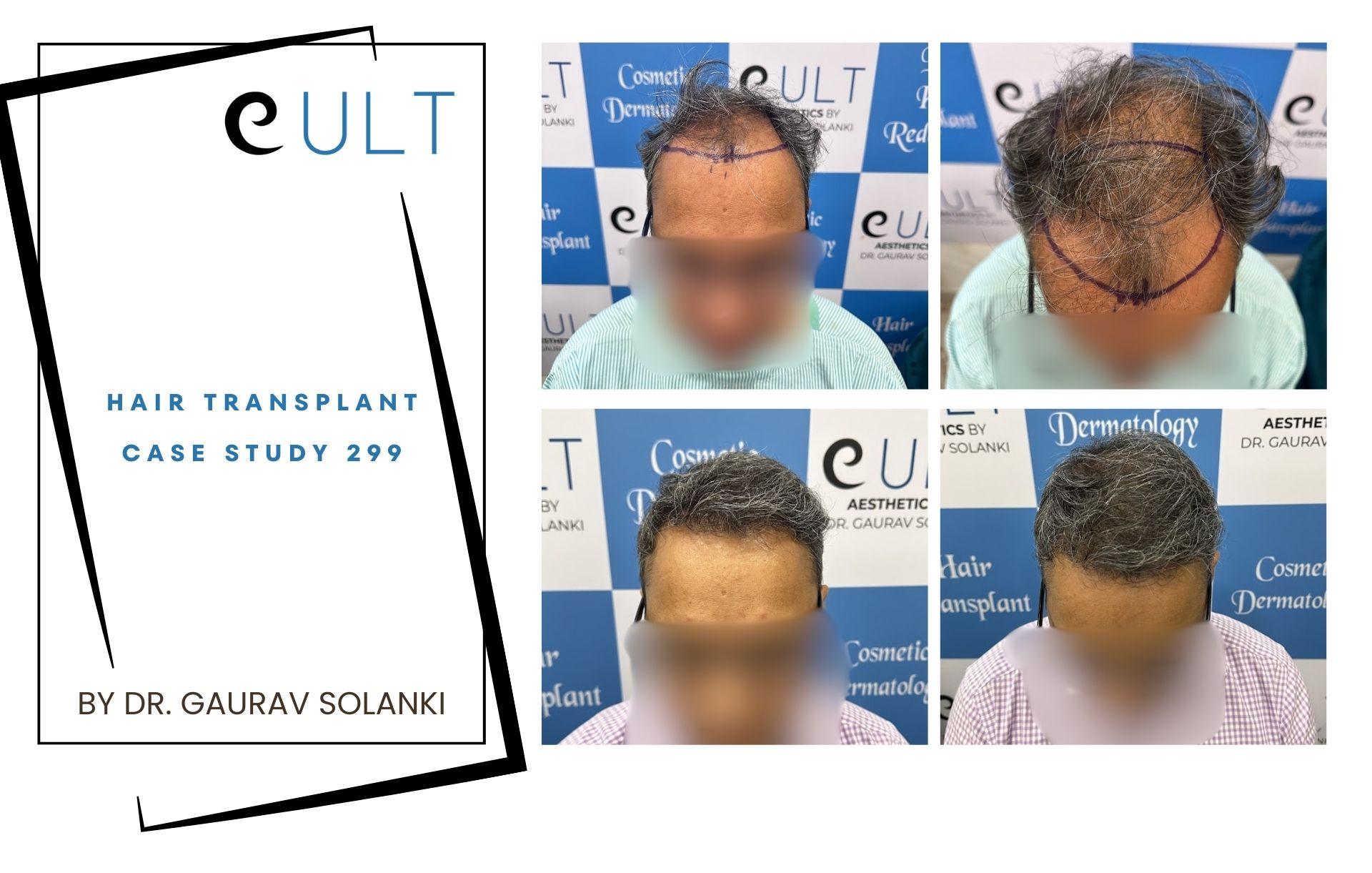 Hair Transplant case 299