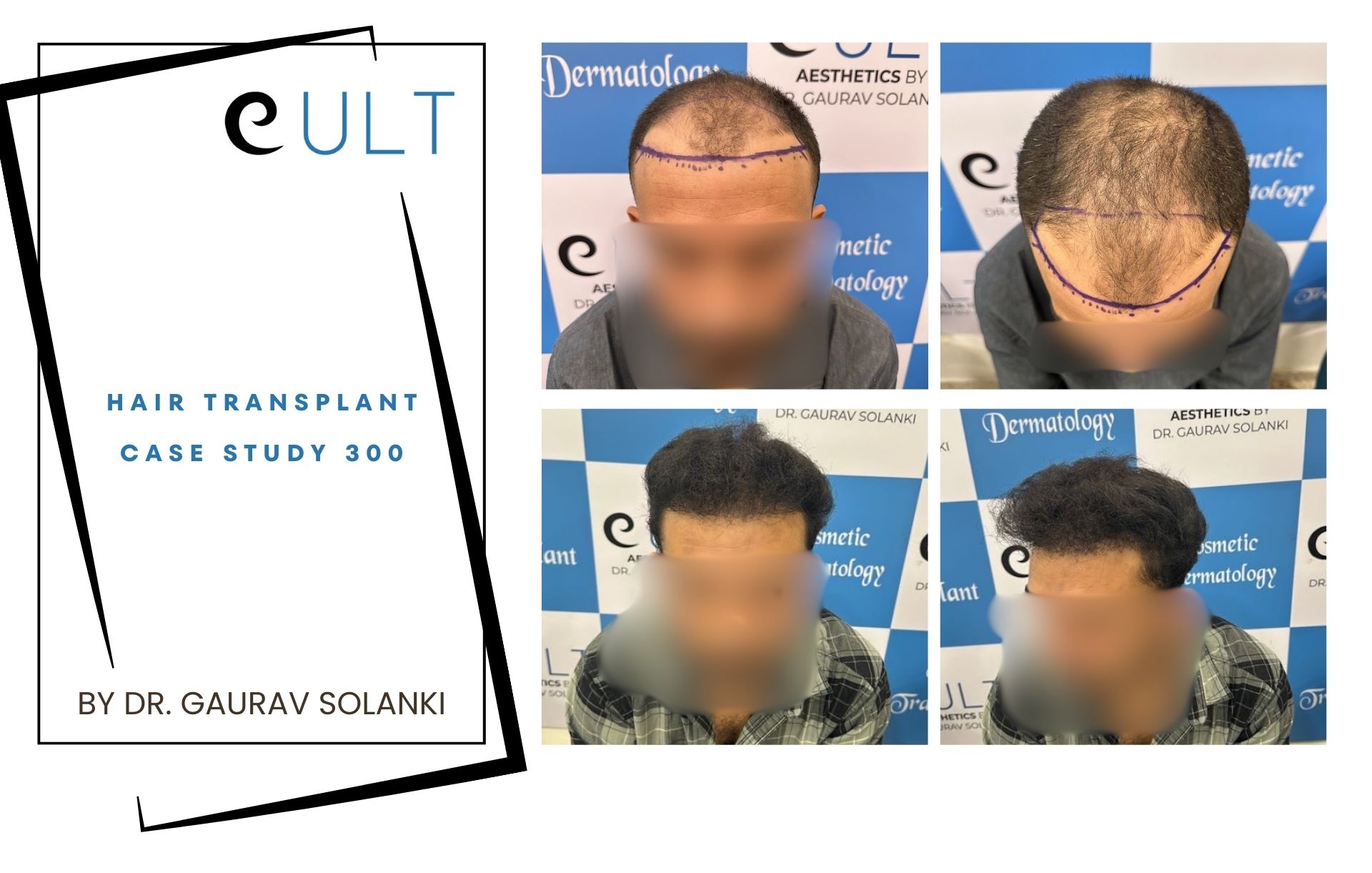 Hair Transplant case 300