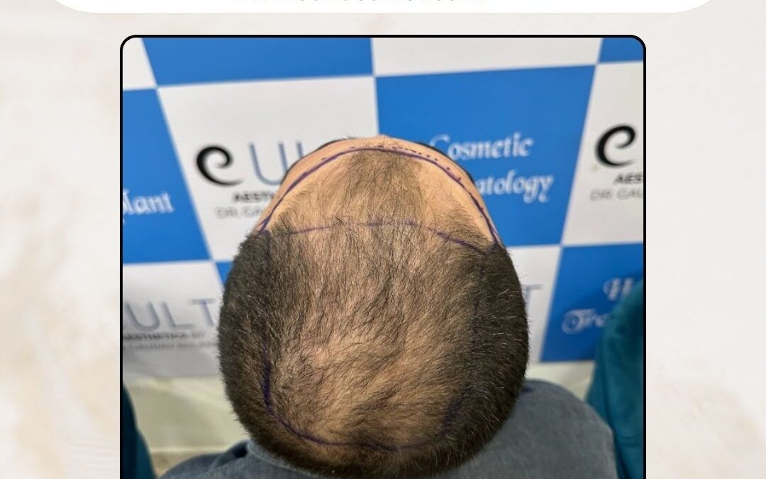 Hair Case 300 Before 3