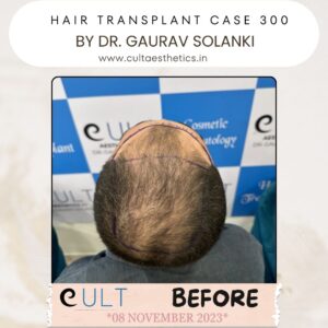 Hair Transplant Case 300 - Before Treatment at Cult Aesthetics Gurgaon