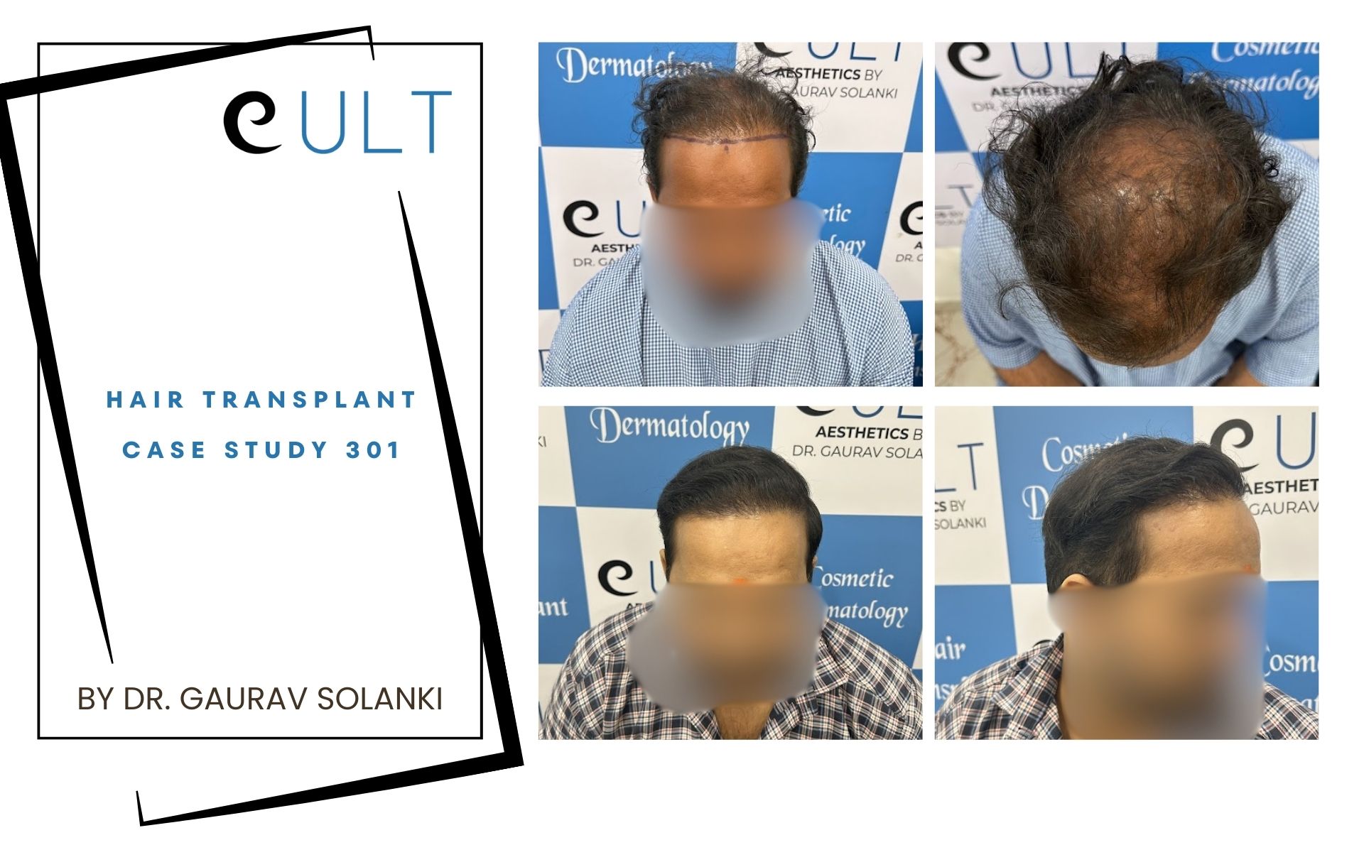 Hair Transplant case 301