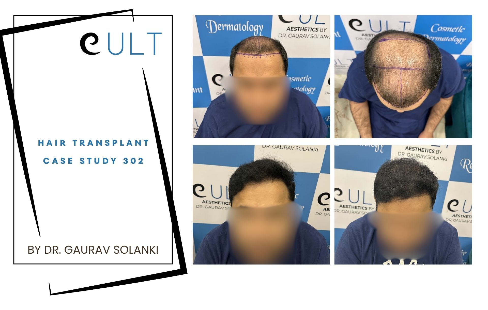 Hair Transplant case 302