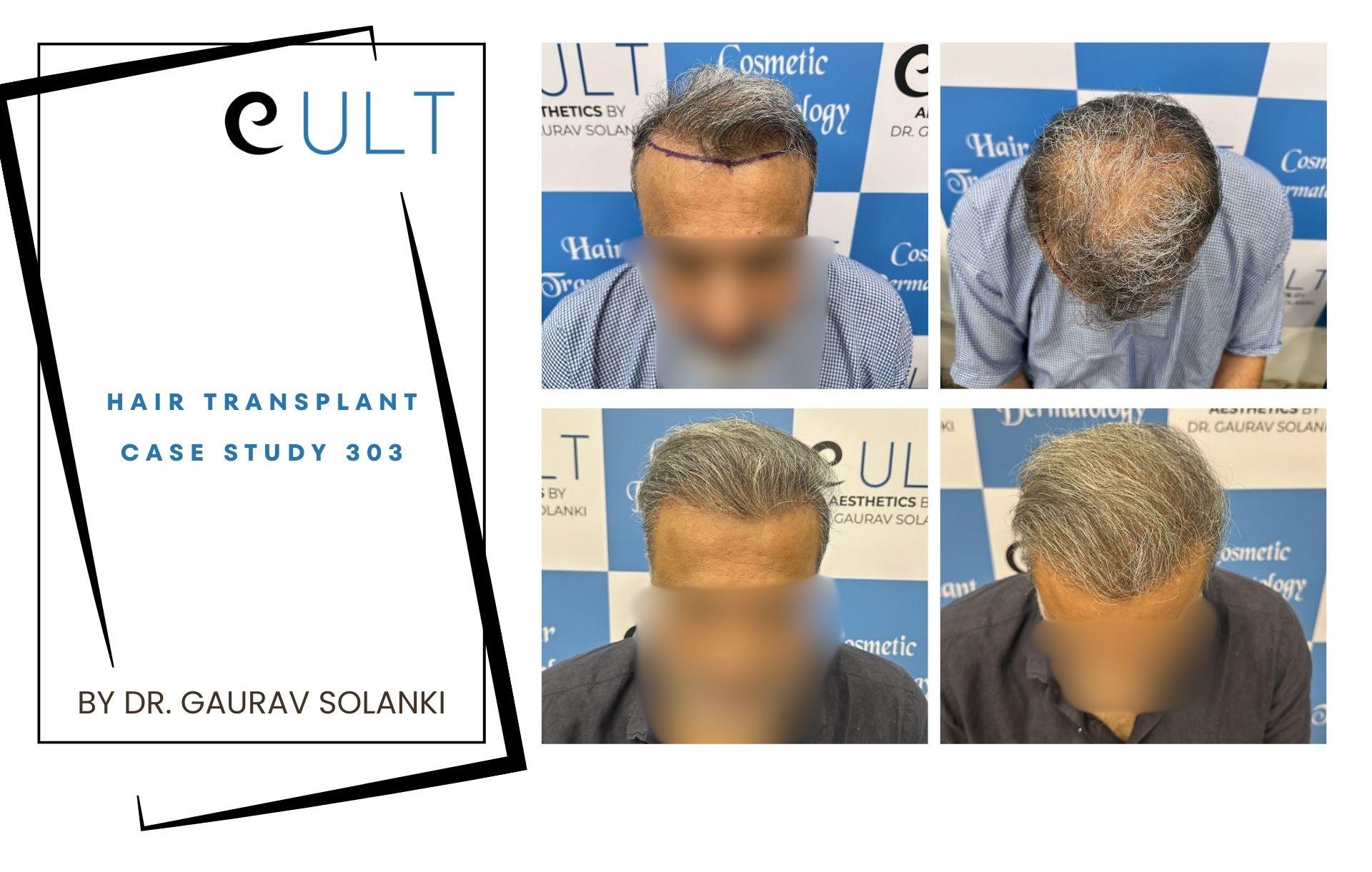 Hair Transplant case 303