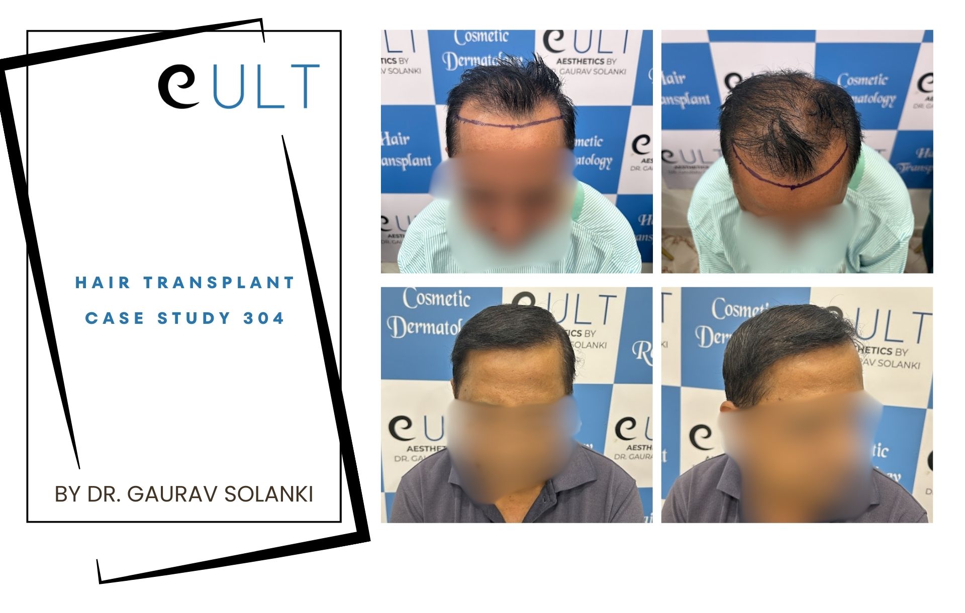 Hair Transplant case 304