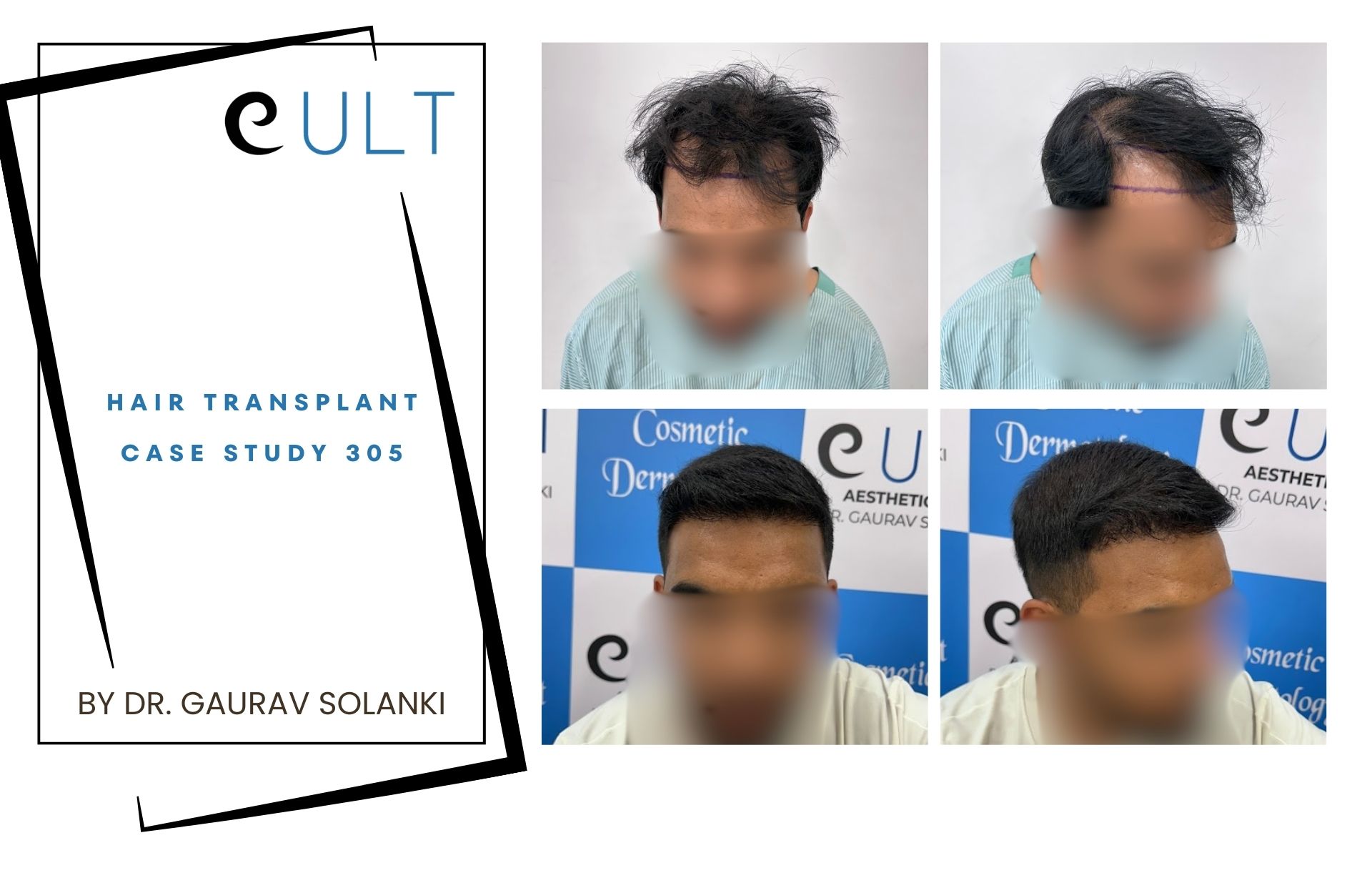 Hair Transplant case 305