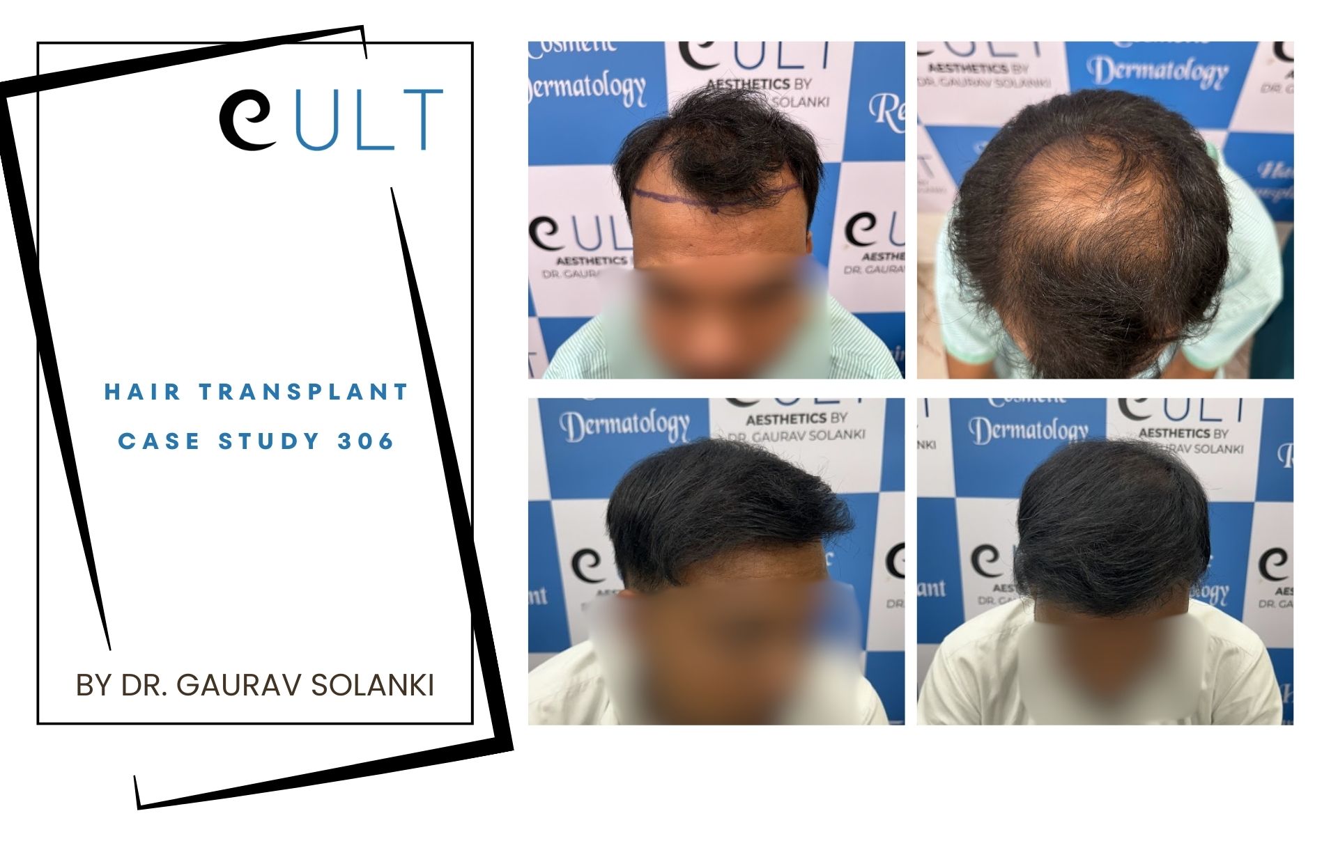 Hair Transplant case 306