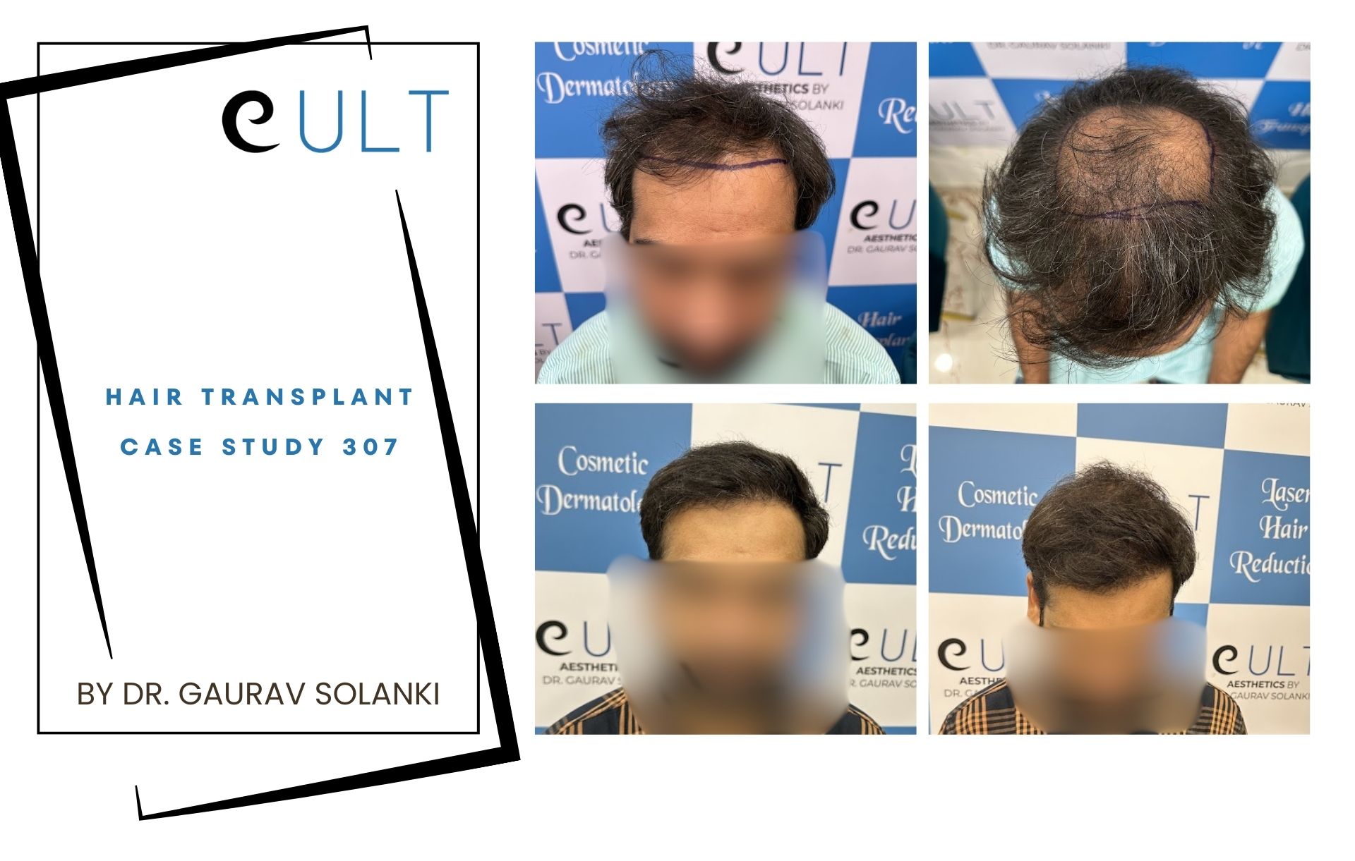 Hair Transplant case 307