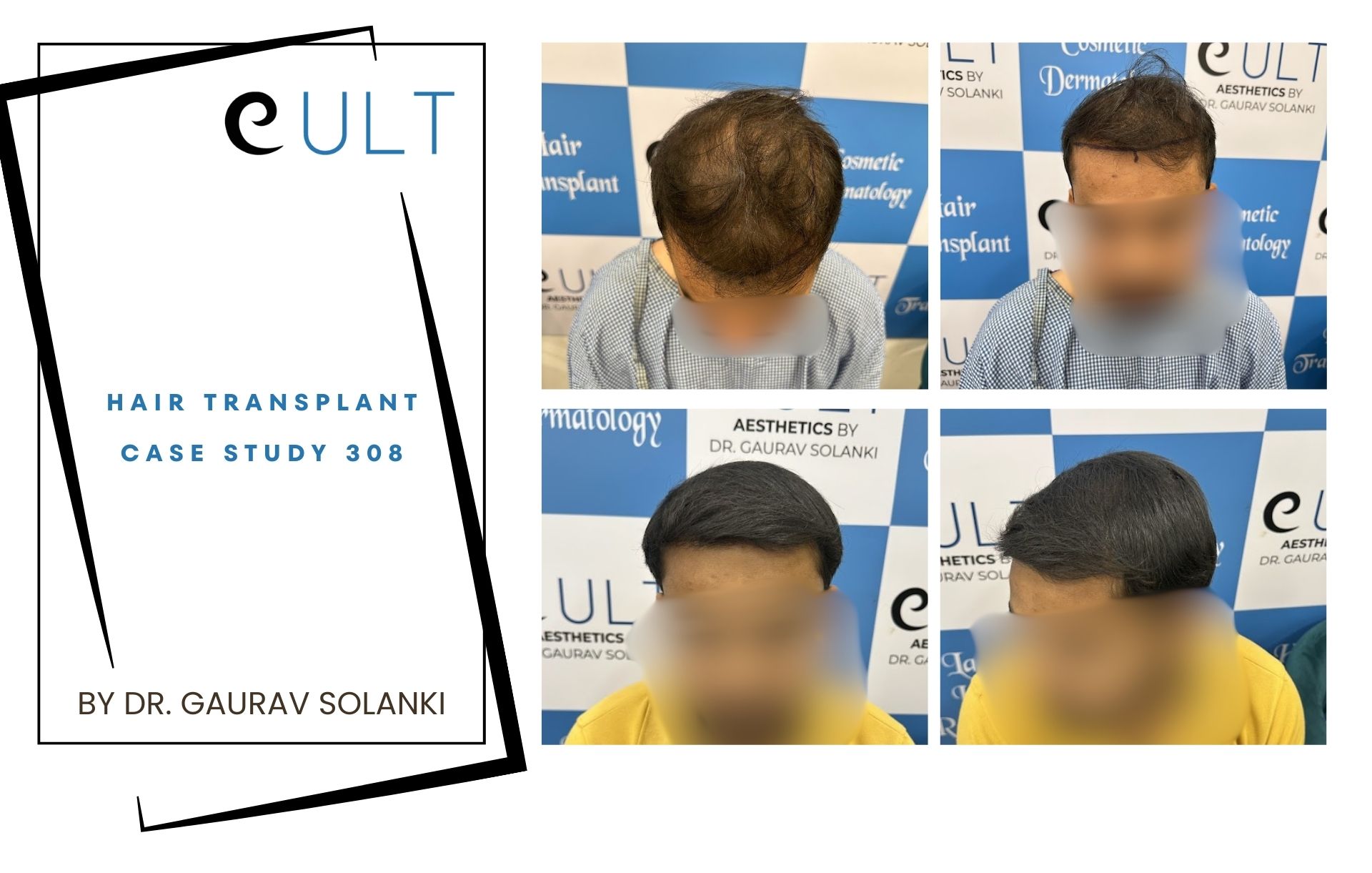 Hair Transplant case 308