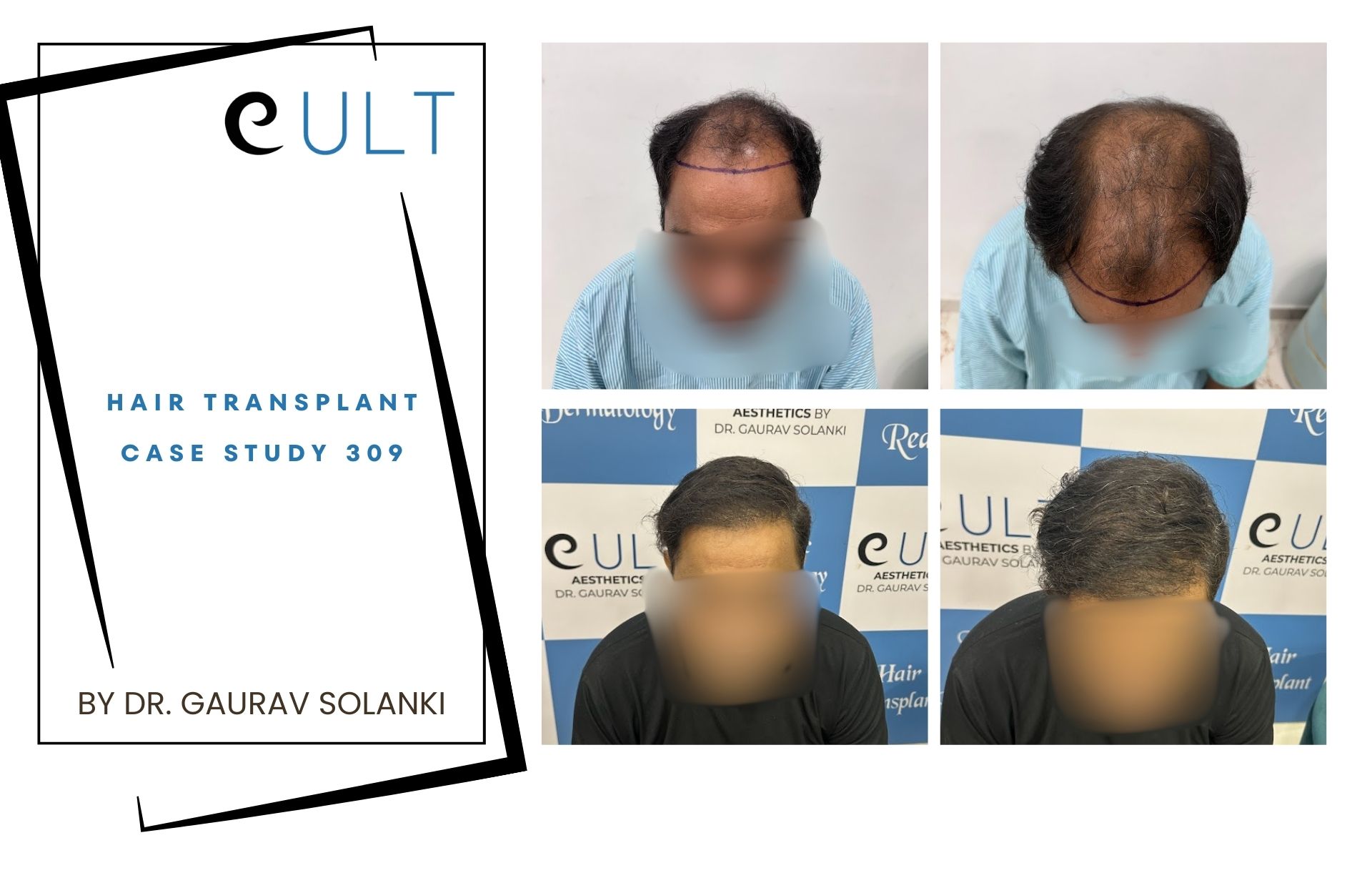 Hair Transplant case 309