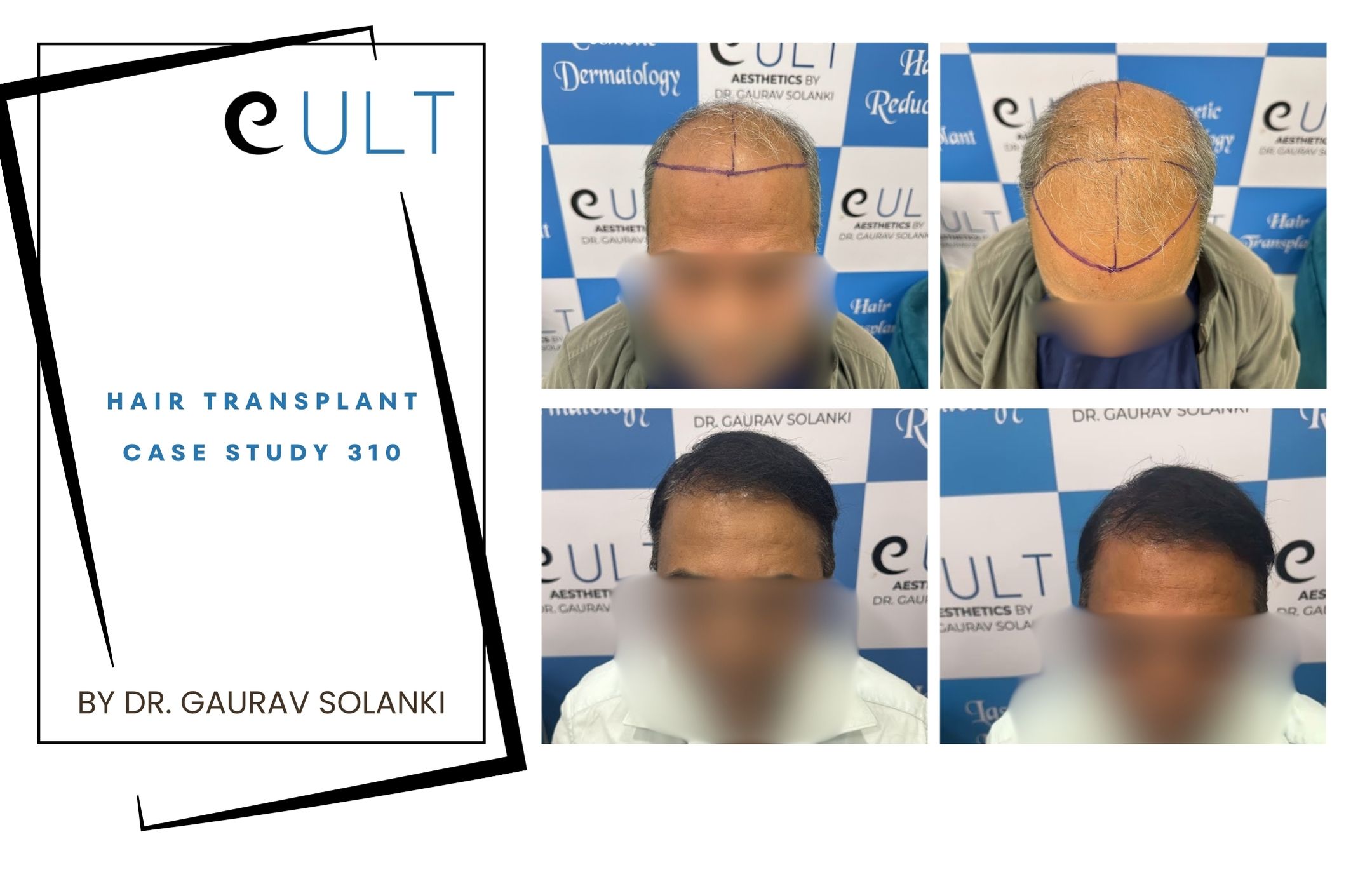 Hair Transplant case 310