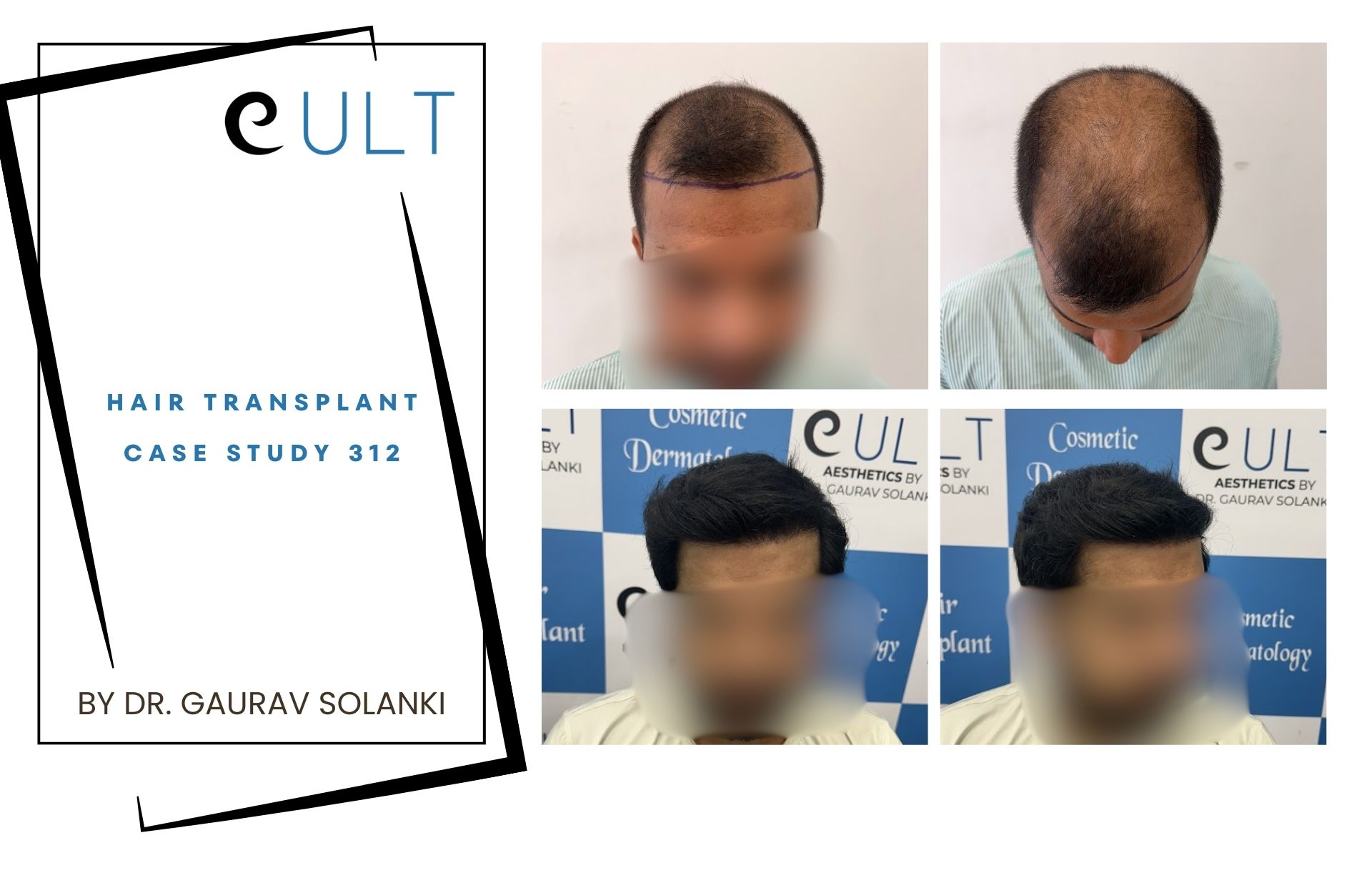 Hair Transplant case 312