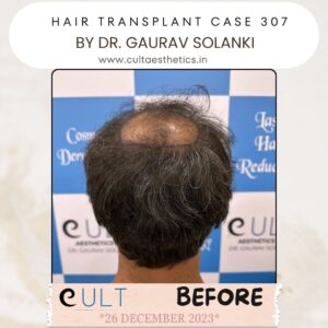 Hair Transplant Case 307 - Before Treatment at Cult Aesthetics Gurgaon