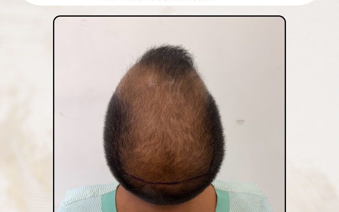 Hair Case 312 Before 3