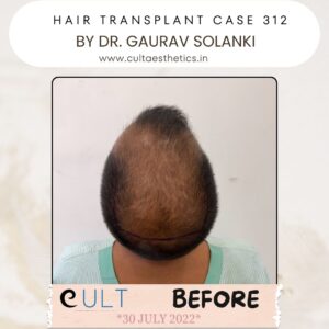 Hair Transplant Case 312 - Before Treatment at Cult Aesthetics Gurgaon