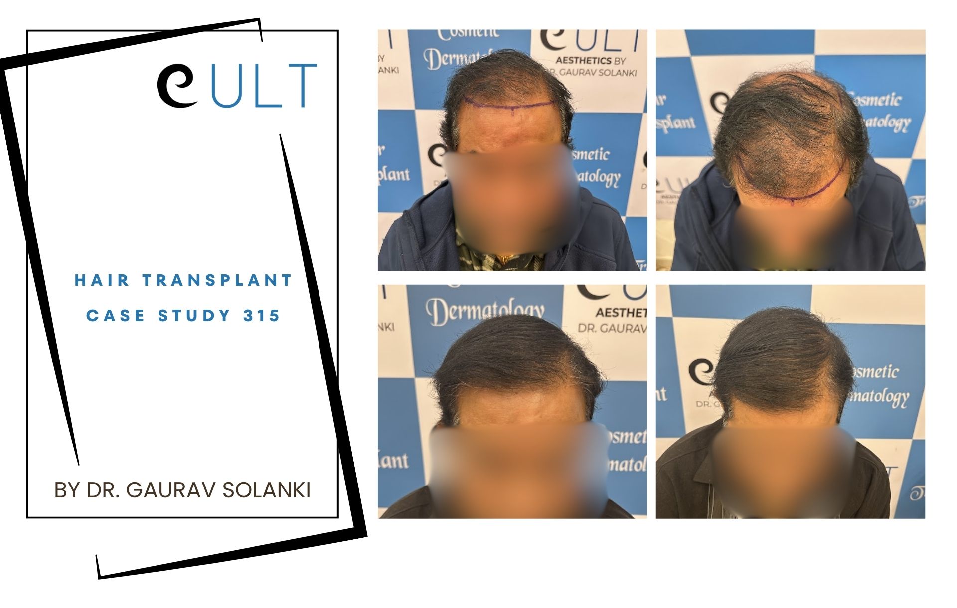 Hair Transplant case 315