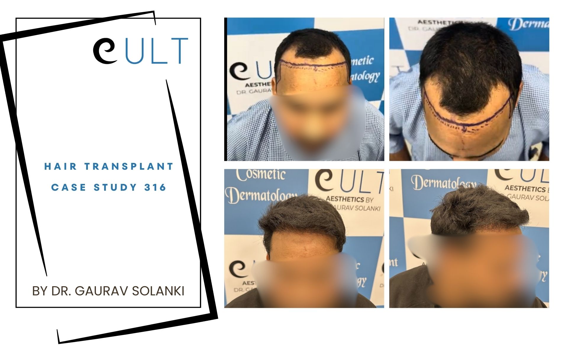 Hair Transplant case 316