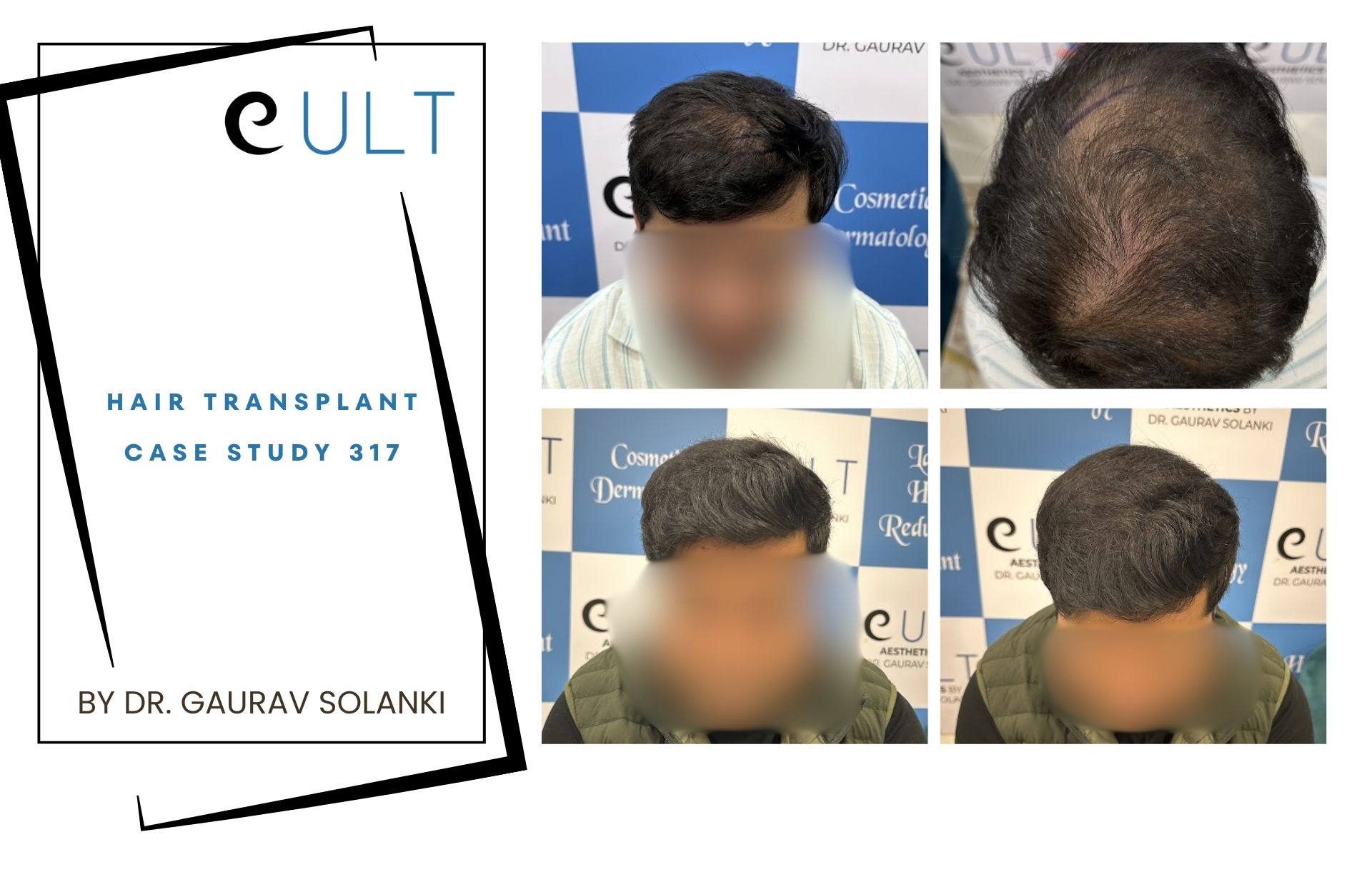 Hair Transplant case 317