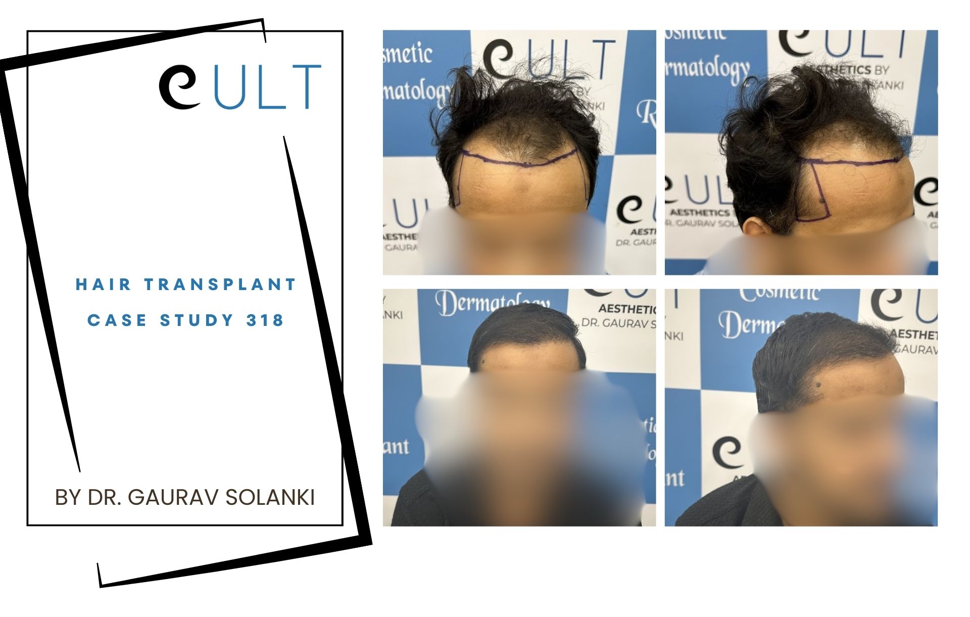 Hair Transplant case 318