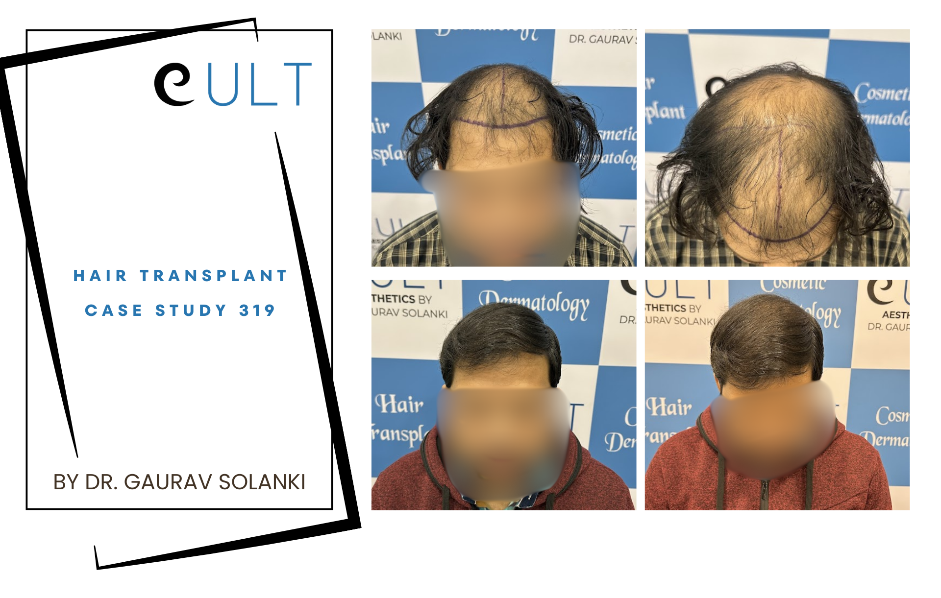 Hair Transplant case 319