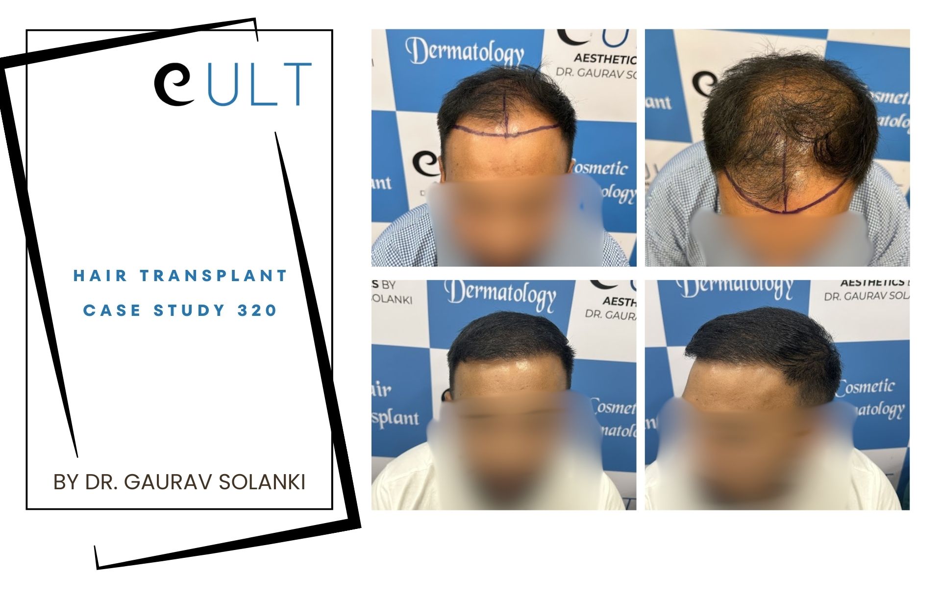 Hair Transplant case 320