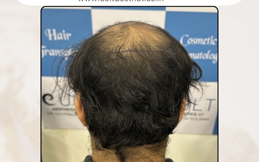 Hair Case 319 Before 4