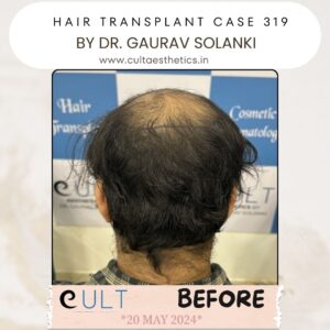 Hair Transplant Case 319 - Before Treatment at Cult Aesthetics Gurgaon