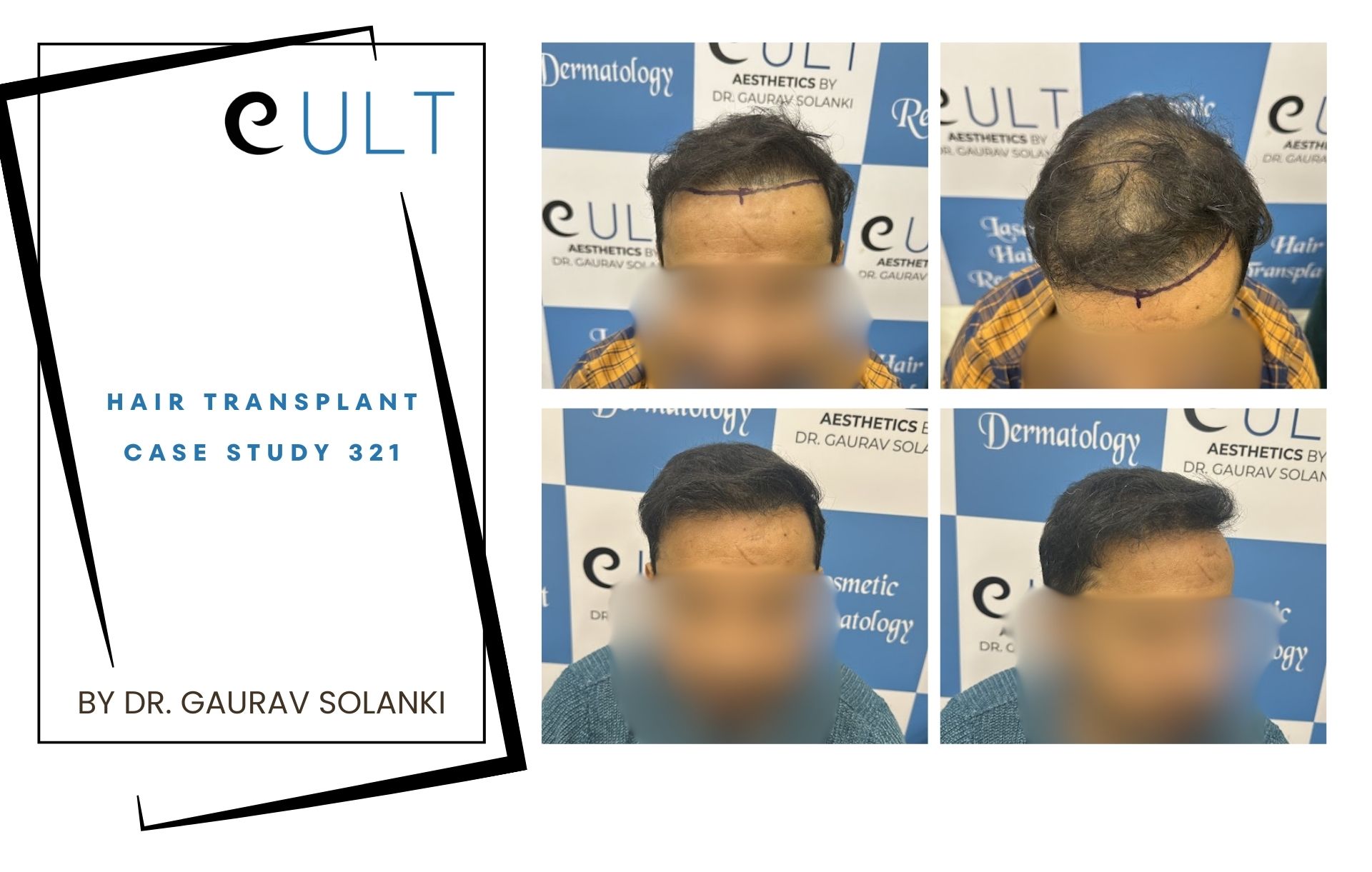 Hair Transplant case 321