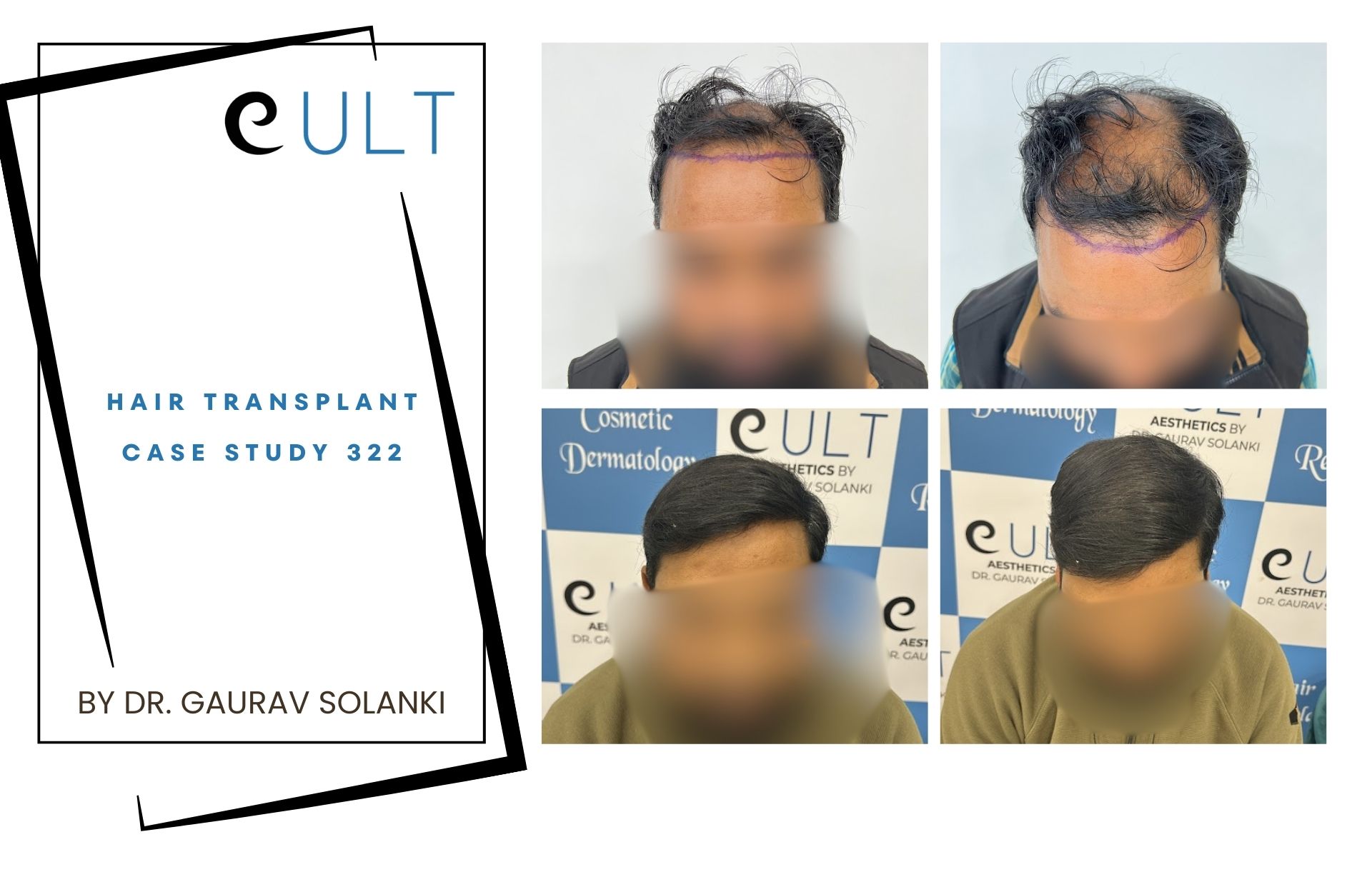 Hair Transplant case 322