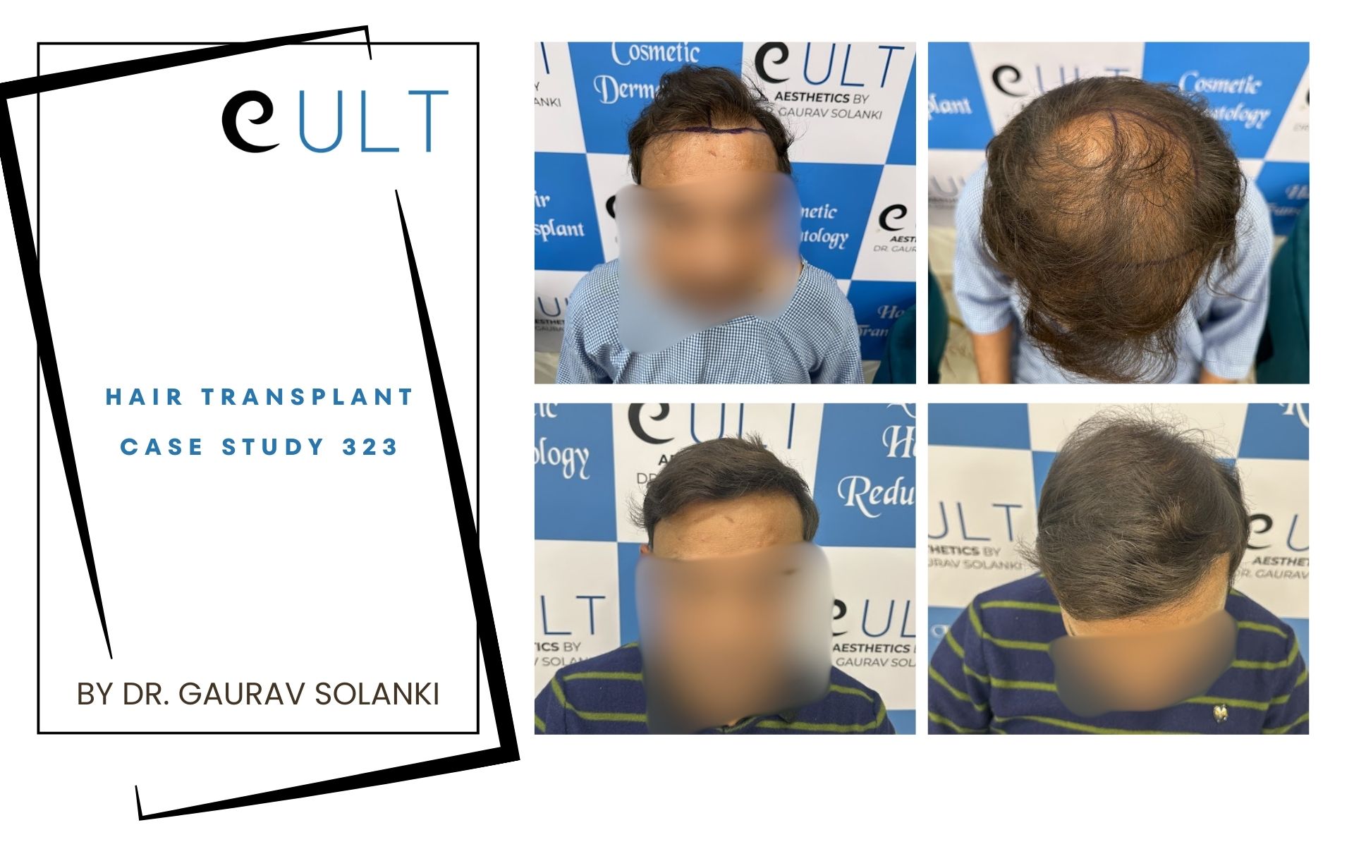 Hair Transplant case 323