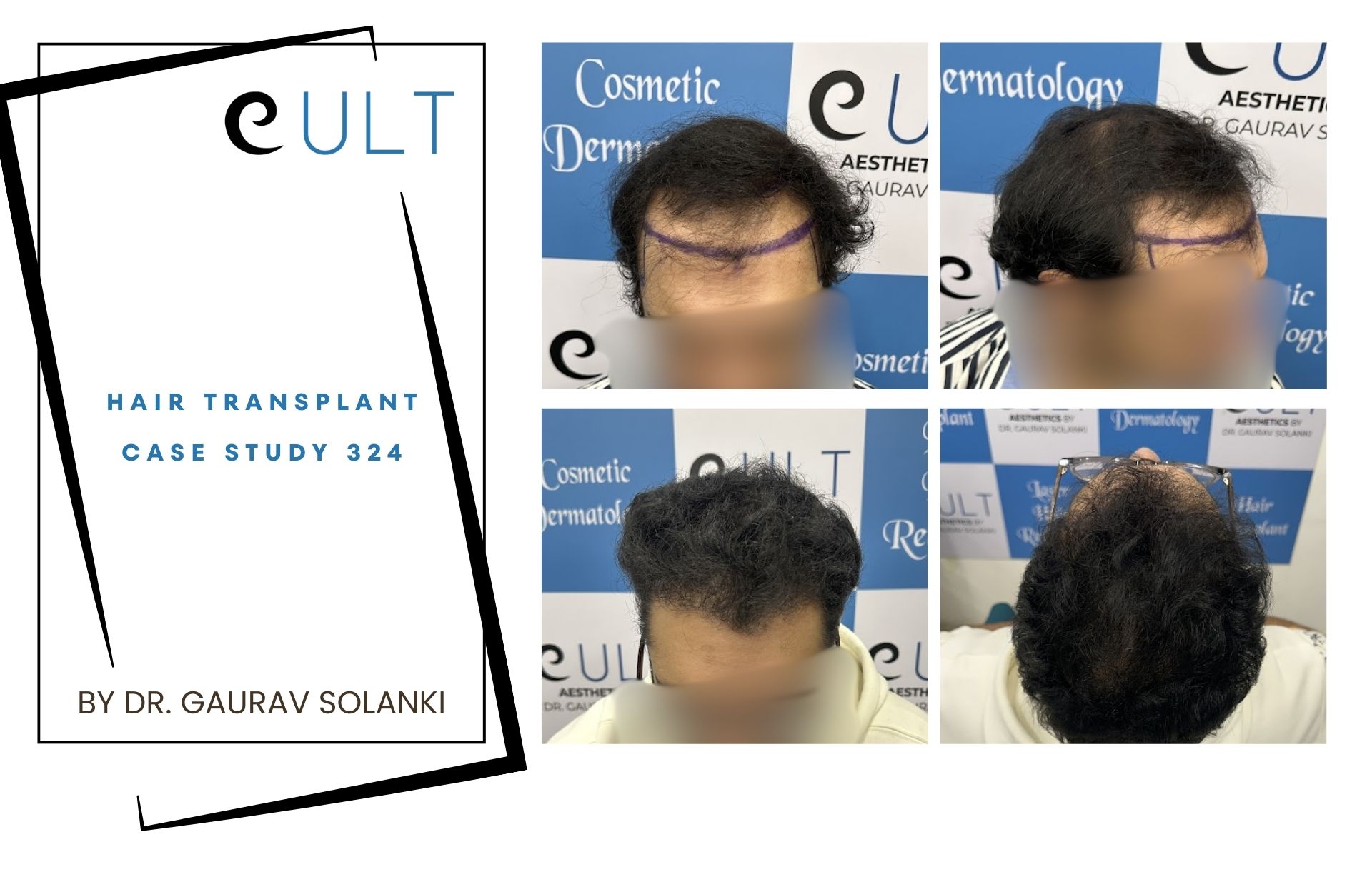 Hair Transplant case 324