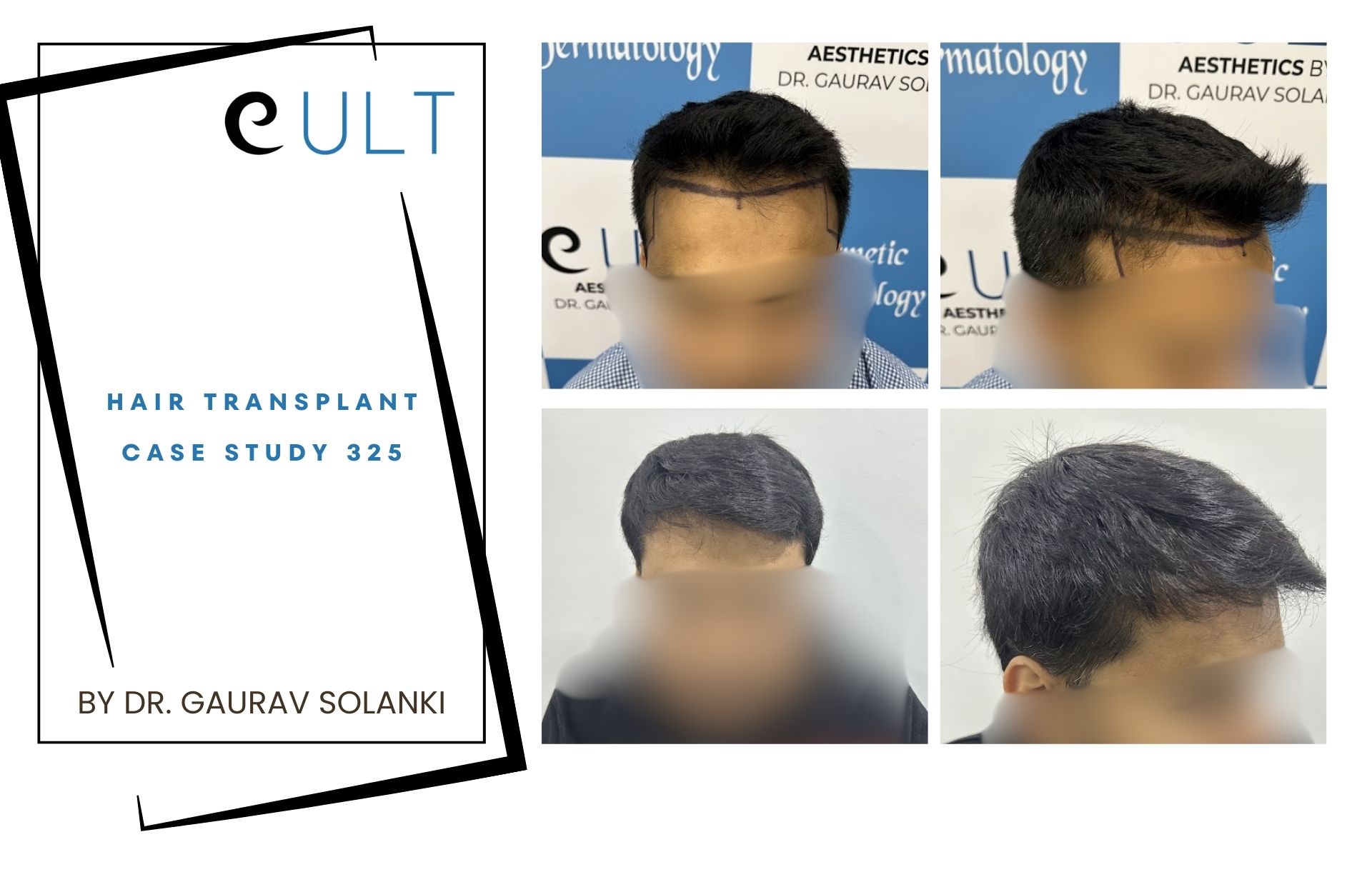 Hair Transplant case 325