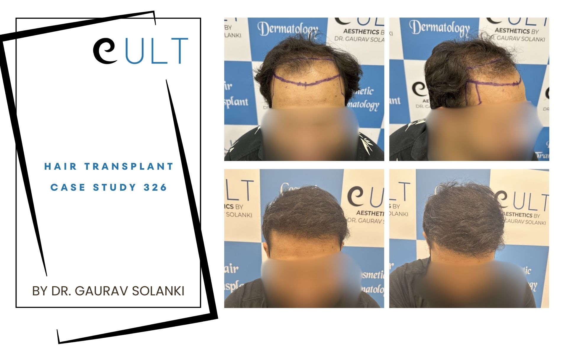 Hair Transplant case 326