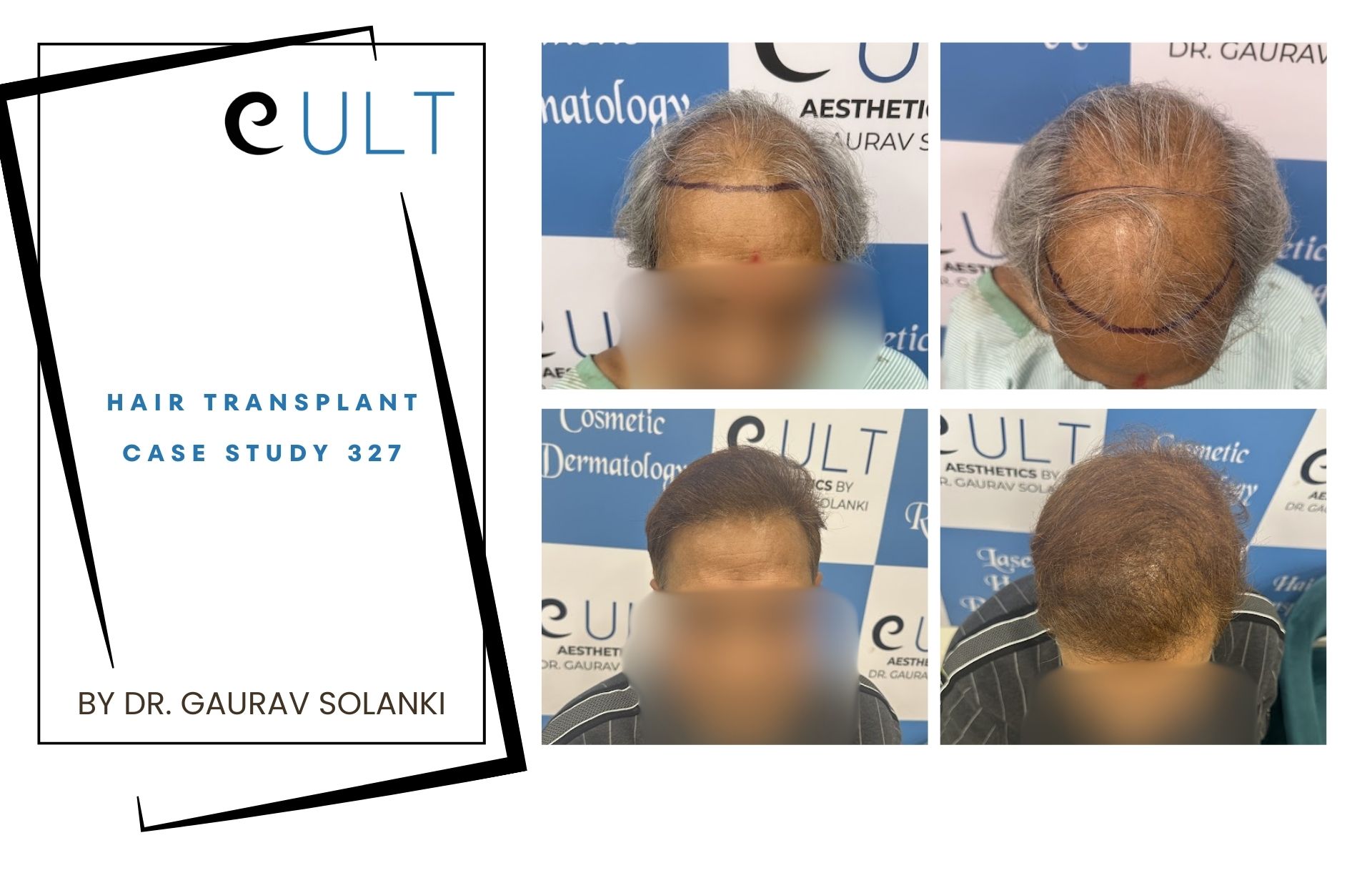 Hair Transplant case 327