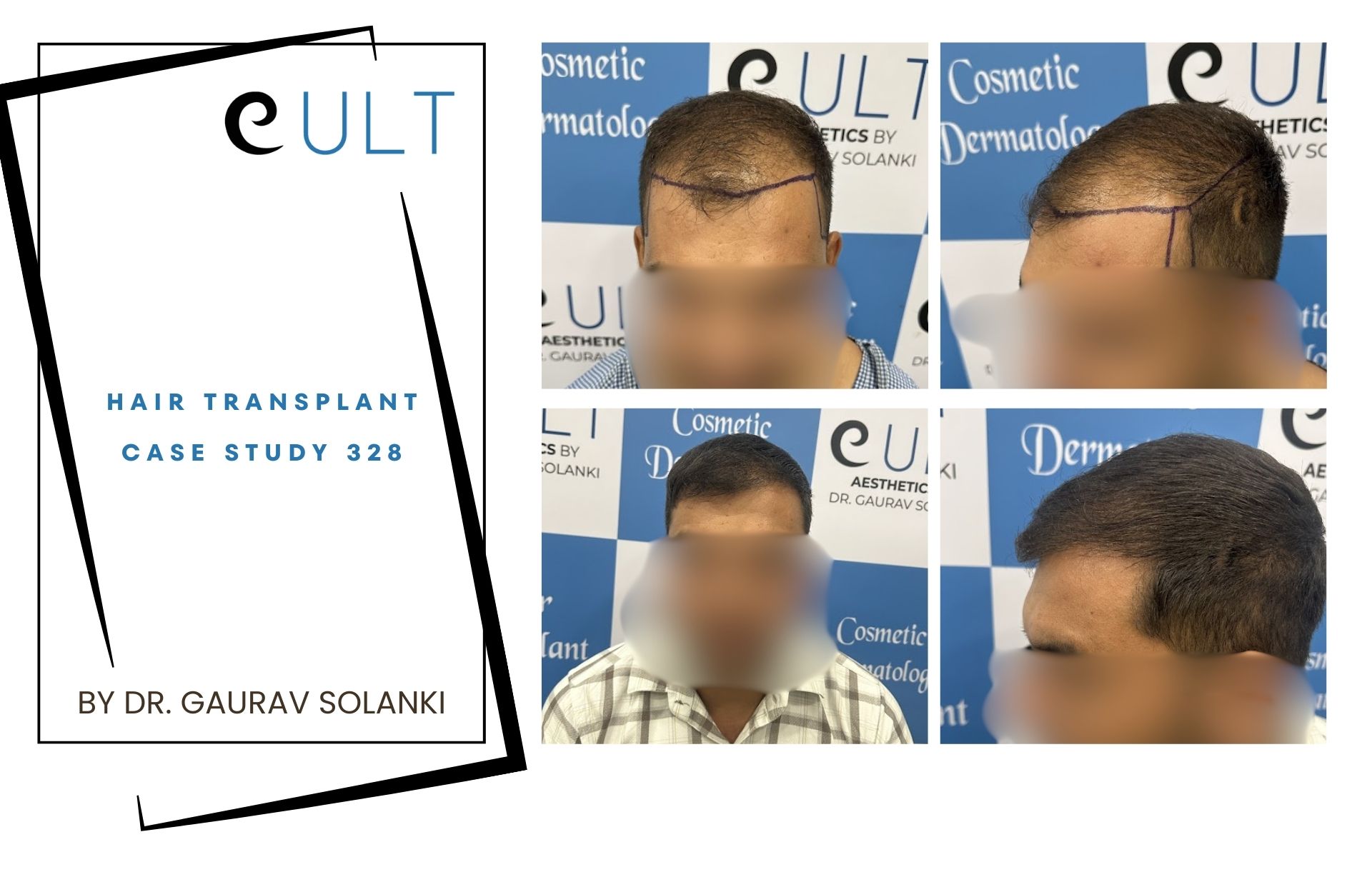 Hair Transplant case 328