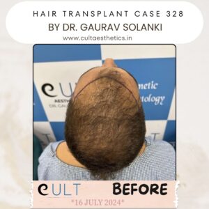 Hair Transplant Case 328 - Before Treatment at Cult Aesthetics Gurgaon
