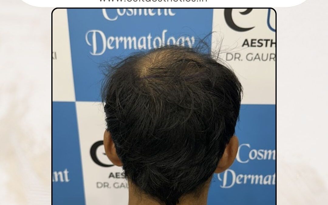 Hair Case 330 Before 4
