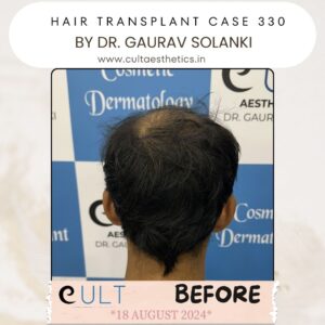 Hair Transplant Case 330 - Before Treatment at Cult Aesthetics Gurgaon