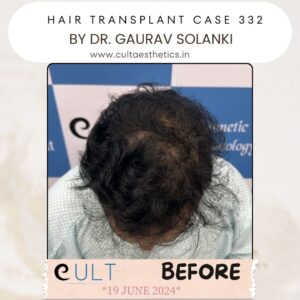 Hair Transplant Case 332 - Before Treatment at Cult Aesthetics Gurgaon