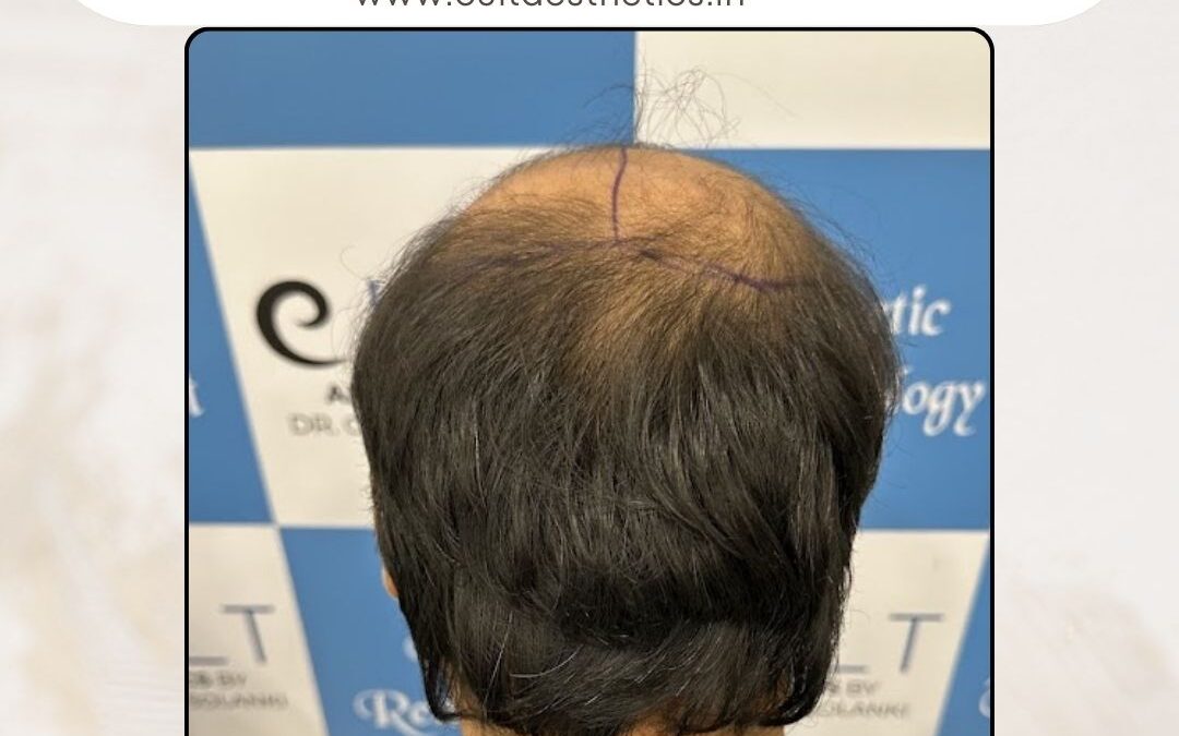 Hair Case 342 Before 4